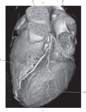 Refer to the figure below.    -Which arrow points to the left ventricle? A)  A B)  B C)  C D)  D