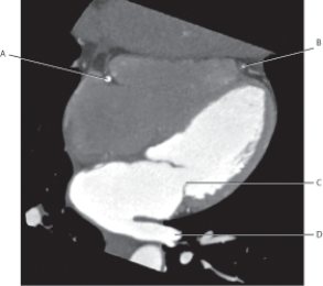 Refer to the figure below of a horizontal long axis CT.    -Which arrow points to the bicuspid valve? A)  A B)  B C)  C D)  D