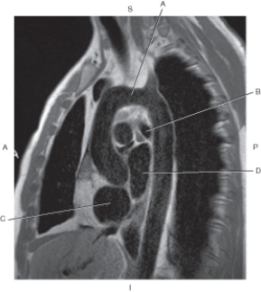Refer to the figure below of a sagittal, T1-weighted MRI of the heart with left atrium.    -Which arrow points to the left mainstem bronchus? A)  A B)  B C)  C D)  D
