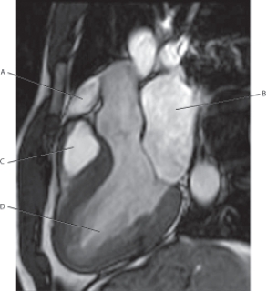 Refer to the figure below of an LVOT MRI.    -Which arrow points to the left atrium? A)  A B)  B C)  C D)  D