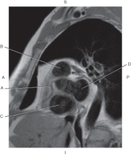 Refer to the figure below of a sagittal, T1-weighted MRI of the heart with pulmonary trunk.    -Which arrow points to the right coronary artery? A)  A B)  B C)  C D)  D