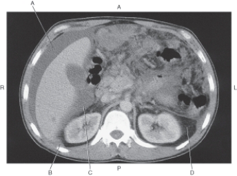 In the figure below of an axial CT of the abdomen,which arrow points to Morison's pouch?   A)  A B)  B C)  C D)  D
