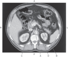 In the figure below of an axial CT of the abdomen,which arrow points to the splenic vein?   A)  A B)  B C)  C D)  D