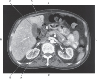 In the figure below of an axial CT of the pancreas and pancreatic duct,which arrow points to the common bile duct?   A)  A B)  B C)  C D)  D