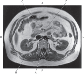 In the figure below of an axial MR of the abdomen,which arrow points to the superior mesenteric artery?   A)  A B)  B C)  C D)  D