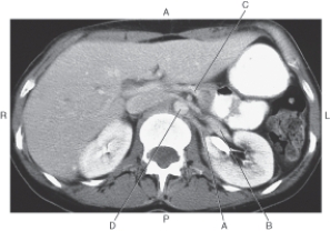 In the figure below of an axial CT of the abdomen,which arrow points to the left renal vein?   A)  A B)  B C)  C D)  D
