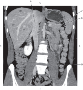 Refer to the figure below of a coronal CT reformat of liver segments.    -Which arrow points to the spleen? A)  A B)  B C)  C D)  D