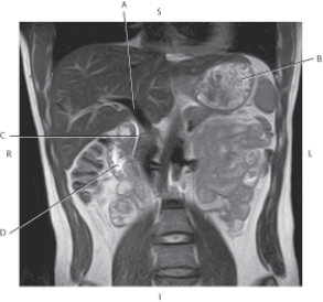 Refer to the figure below of a coronal, T2-weighted MRI of the abdomen and CBD.    -Which arrow points to the stomach? A)  A B)  B C)  C D)  D