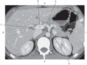Refer to the figure below of an axial CT of the abdomen.    -Which arrow points to the right hepatic duct? A)  A B)  B C)  C D)  D
