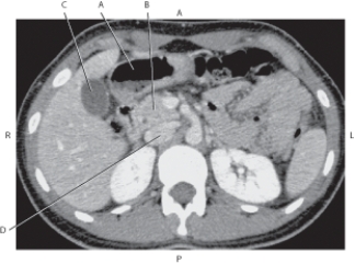 Refer to the figure below of an axial CT of the abdomen.    -Which arrow points to the gallbladder? A)  A B)  B C)  C D)  D