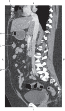 Refer to the figure below of a sagittal CT reformat of the pancreas and IVC.    -Which arrow points to the liver? A)  A B)  B C)  C D)  D