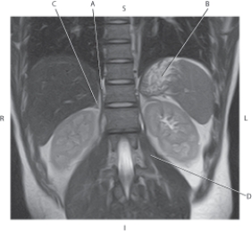 Refer to the figure below.    -Which arrow points to the right adrenal gland? A)  A B)  B C)  C D)  D