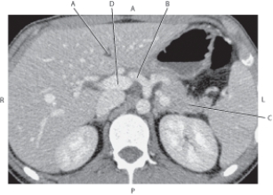 Refer to the figure below.    -Which arrow is pointing to the tail of the pancreas? A)  A B)  B C)  C D)  D