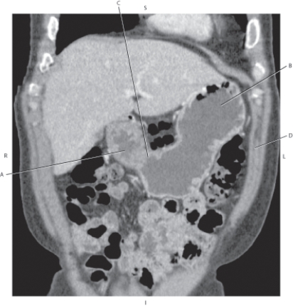 Refer to the figure below.    -Which arrow points to the fundus of stomach? A)  A B)  B C)  C D)  D