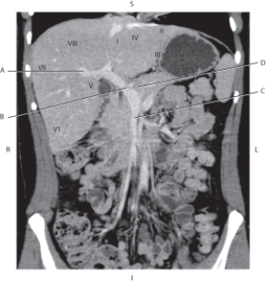 Refer to the figure below.    -Which arrow points to the superior mesenteric vein? A)  A B)  B C)  C D)  D