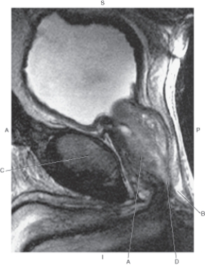 In the figure below of a sagittal MRI of the male pelvis,which arrow points to the prostate gland?   A)  A B)  B C)  C D)  D