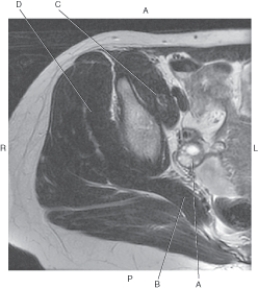 Refer to the figure below of an axial MRI of the female pelvis.    -Which arrow points to the ovary? A)  A B)  B C)  C D)  D