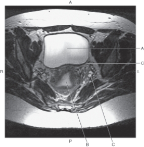 In the figure below of an axial MRI of the female pelvis,which arrow points to the left ovary?   A)  A B)  B C)  C D)  D
