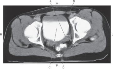 In the figure below of an axial CT of the male pelvis,which arrow points to the seminal vesicle?   A)  A B)  B C)  C D)  D