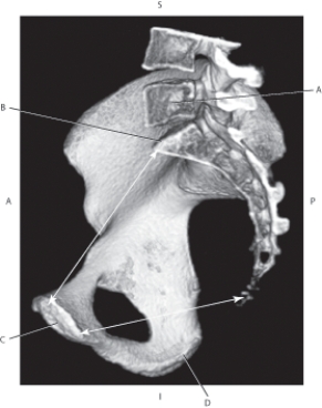 Refer to the figure below of a 3D CT of the pelvis.    -Which arrow points to the ischial tuberosity? A)  A B)  B C)  C D)  D