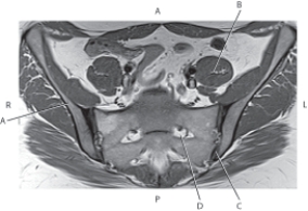 Refer to the figure below of an axial, T1-weighted MRI of the ilium and sacroiliac joints.    -Which arrow points to the ilium? A)  A B)  B C)  C D)  D