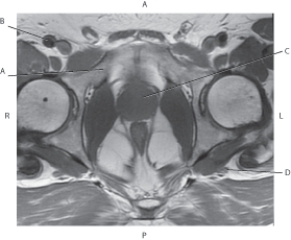Refer to the figure below of an axial, T1-weighted MRI of the male pelvis.    -Which arrow points to the prostate gland? A)  A B)  B C)  C D)  D