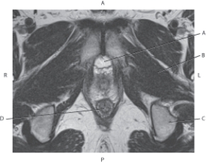 Refer to the figure below of an axial, T2-weighted MRI of the male pelvis.    -Which arrow points to the obturator externus muscle? A)  A B)  B C)  C D)  D