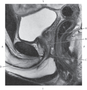 Refer to the figure below of a sagittal, T2-weighted MRI of the male pelvis.    -Which arrow points to the corpus cavernosum? A)  A B)  B C)  C D)  D