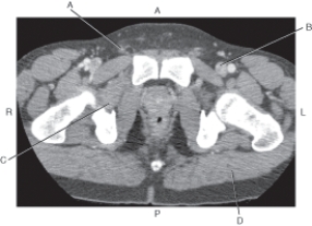 Refer to the figure below of an axial CT of the male pelvis.    -Which arrow points to the obturator externus muscle? A)  A B)  B C)  C D)  D