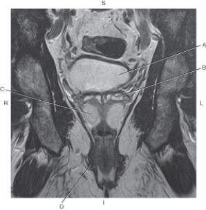 Refer to the figure below of a coronal, T2-weighted MRI of the male pelvis.    -Which arrow points to the seminal vesicle? A)  A B)  B C)  C D)  D
