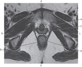 Refer to the figure below of an axial, T2-weighted MRI of a female pelvis.    -Which arrow points to the urethra? A)  A B)  B C)  C D)  D