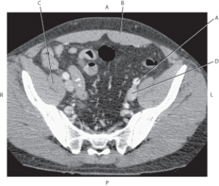 Refer to the figure below of an axial CT of the pelvis.    -Which arrow points to the rectus abdominis muscle? A)  A B)  B C)  C D)  D