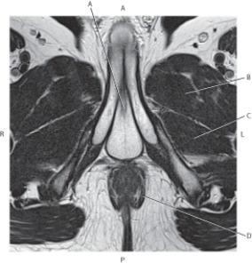 Refer to the figure below of an axial, T2-weighted MRI of the male pelvis.    -Which arrow points to the levator ani muscle? A)  A B)  B C)  C D)  D