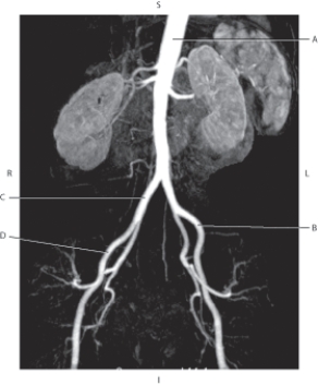 Refer to the figure below of an MRA of the descending aorta.    -Which arrow points to the right common iliac artery? A)  A B)  B C)  C D)  D