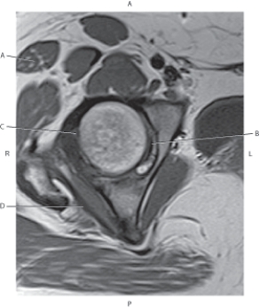 Refer to the figure below of an axial, T1-weighted MRI of the right hip.    -Which arrow points to the obturator internus tendon? A)  A B)  B C)  C D)  D