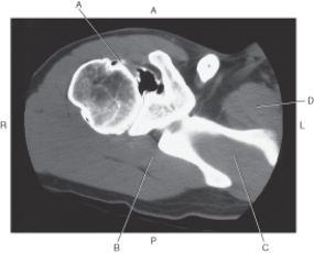 In the figure below of an axial CT of the shoulder,which arrow points to the subscapularis muscle?   A)  A B)  B C)  C D)  D