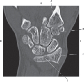 Refer to the figure below of a coronal CT reformat of the wrist.    -Which arrow points to the lunate? A)  A B)  B C)  C D)  D