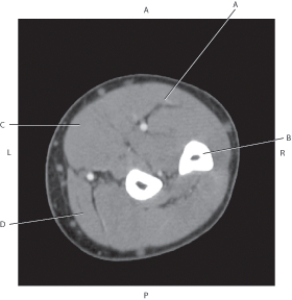 Refer to the figure below of an axial, T1-weighted MRI of the right shoulder.    -Which arrow points to the infraspinatus muscle? A)  A B)  B C)  C D)  D