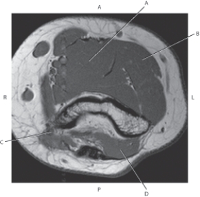 Refer to the figure below of an axial CT of the right forearm.    -Which arrow points to the brachioradialis muscle? A)  A B)  B C)  C D)  D