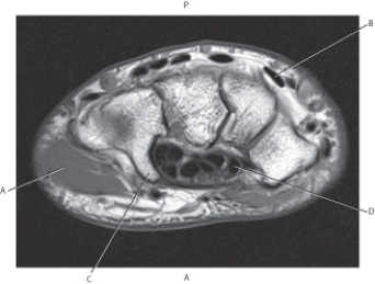 Refer to the figure below of a coronal, T2-weighted MRI of the wrist.    -Which arrow points to the midcarpal joint? A)  A B)  B C)  C D)  D