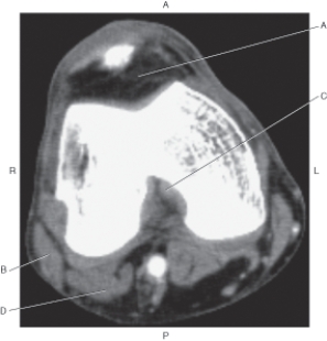 Refer to the figure below of an axial CT of the knee.    -Which arrow points to the infrapatellar fat pad (Hoffa's fat pad) ? A)  A B)  B C)  C D)  D