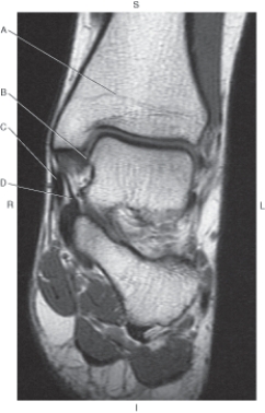 In the figure below of a coronal MR of the ankle,which arrow points to the tibiotalar ligament?   A)  A B)  B C)  C D)  D