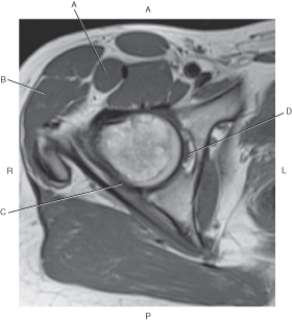 Refer to the figure below of an axial, T1-weighted MRI of the right hip.    -Which arrow is pointing to the ischiofemoral ligament? A)  A B)  B C)  C D)  D