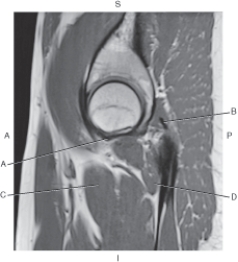 Refer to the figure below of a sagittal, T1-weighted MRI of the hip.    -Which arrow is pointing to the quadratus femoris muscle? A)  A B)  B C)  C D)  D