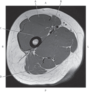 Refer to the figure below of an axial, T1-weighted MRI of the right proximal femur.    -Which arrow is pointing to the sartorius muscle? A)  A B)  B C)  C D)  D