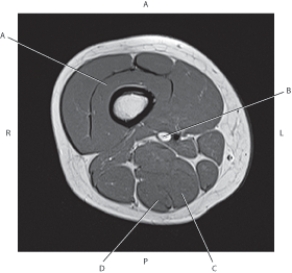 Refer to the figure below of an axial, T1-weighted MRI of the right distal femur.    -Which arrow is pointing to the semimembranosus muscle? A)  A B)  B C)  C D)  D