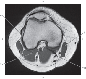 Refer to the figure below of an axial, T1-weighted MRI of the distal right femur.    -Which arrow is pointing to the IT band? A)  A B)  B C)  C D)  D