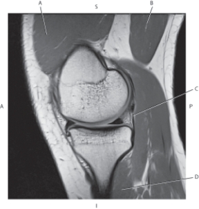 Refer to the figure below of a sagittal, T1-weighted MRI of the knee.    -Which arrow is pointing to the vastus medialis muscle? A)  A B)  B C)  C D)  D