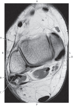 Refer to the figure below of an axial, T1-weighted image of the right ankle.    -Which arrow is pointing to the extensor retinaculum? A)  A B)  B C)  C D)  D