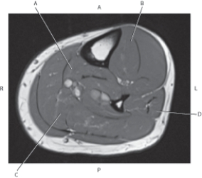 Refer to the figure below of an axial, T1-weighted MRI of the left tibia.    -Which arrow is pointing to the flexor digitorum longus muscle? A)  A B)  B C)  C D)  D